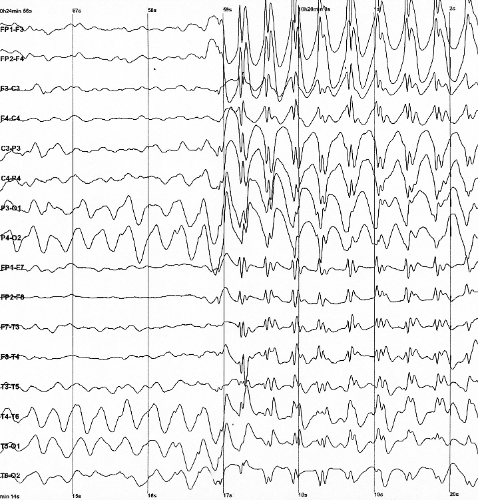 Clinical experts offer advice on prescribing cannabis medicines to patients with epilepsy