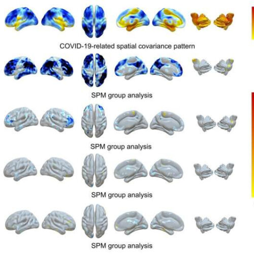 Molecular imaging uncovers effects of COVID-19 on the brain