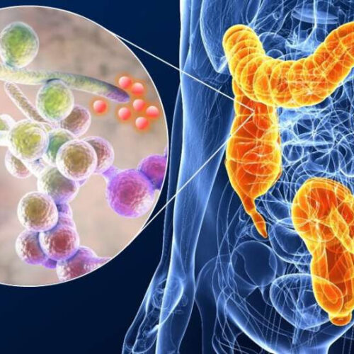 Toxin-producing yeast strains in the gut fuel inflammatory bowel disease