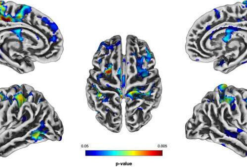 Experts discover brain differences in young children with binge eating disorder