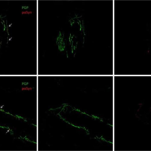 Skin biopsy can help identify patients with Parkinson’s disease