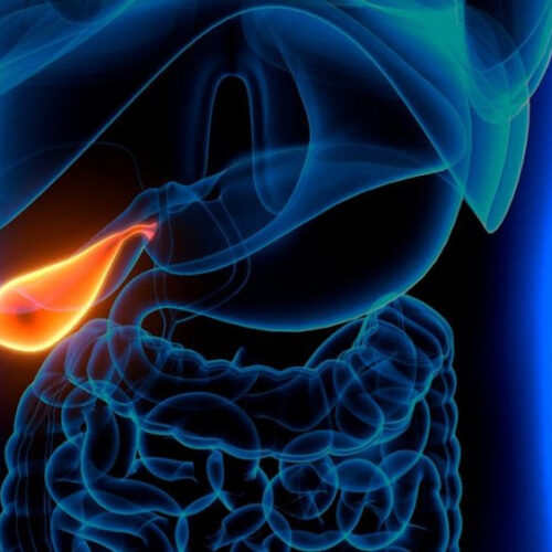 Diabetes and Gallstones: Is There a Link?