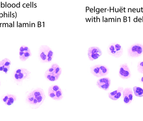 Gene deletion behind anomaly in blood cancer cells