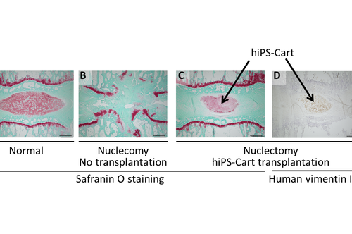 Researchers from Osaka University and Kyoto University develop a stem cell-based biomaterial that can help regenerate tissue associated with low back pain and spinal issues