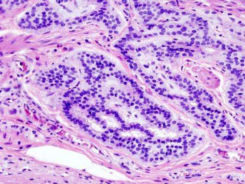 ‘Keto’ molecule may be useful in preventing and treating colorectal cancer, study suggests