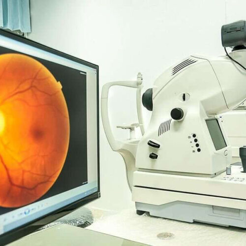 Rate of retinal vein occlusions up after COVID-19 infection