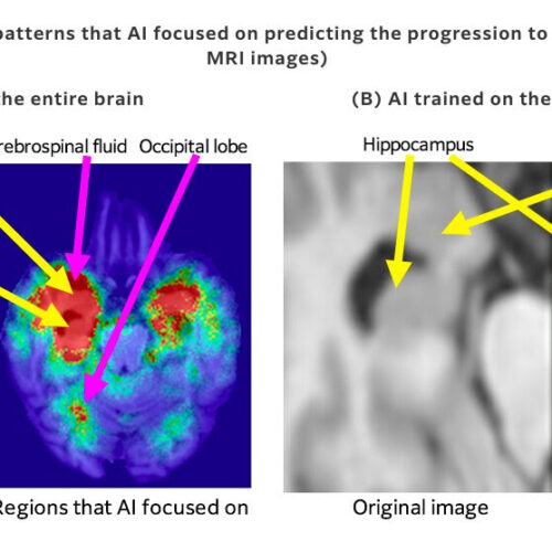 Fujifilm develops AI tech for predicting Alzheimer’s progression