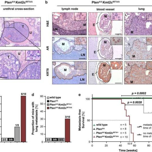 Cause of metastasis in prostate cancer discovered