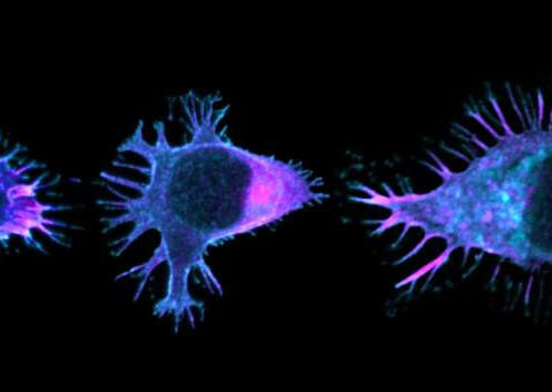 How mutation of the APC gene disrupts lymphocyte migration in colon cancer