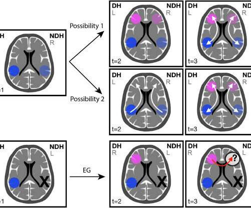 Woman with no left temporal lobe developed a language network in the right side of her brain