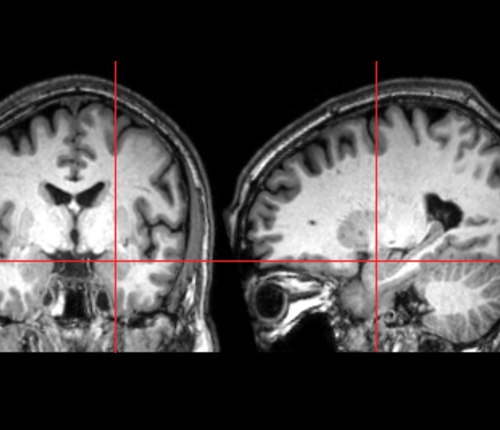 THE AMYGDALA GROWS TOO FAST IN BABIES WHO DEVELOP AUTISM