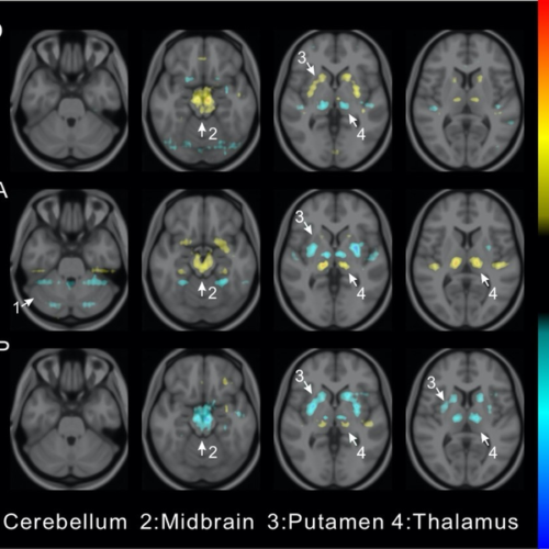 Novel deep learning method provides early and accurate differential diagnosis for Parkinsonian diseases