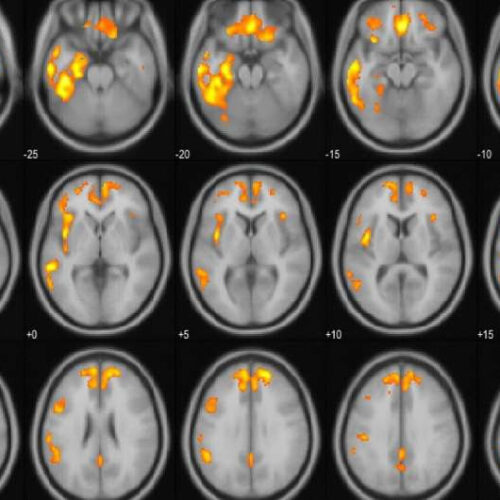 Brainstem atrophy is linked to extrapyramidal symptoms in frontotemporal dementia