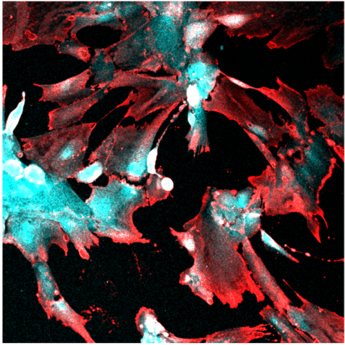 COVID-19 can directly infect and damage human kidney cells