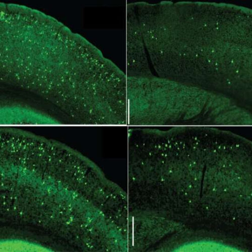 Key signaling pathway in immune cells could be new Alzheimer’s target