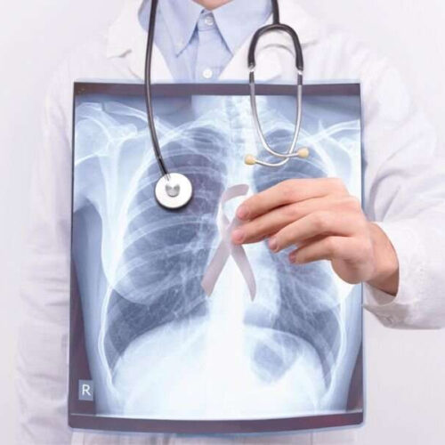 Opdivo may bring survival boost for lung cancer patients