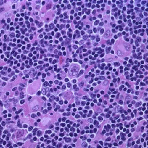 NK cells combined with bispecific antibody showed strong response for patients with lymphoma