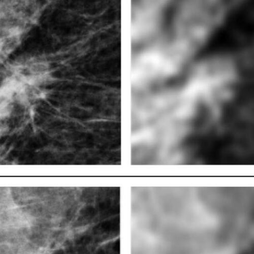 Radiologists, AI systems show differences in breast-cancer screenings, new case study finds