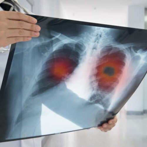 Nearly half of patients at high risk for lung cancer delayed screening follow-up