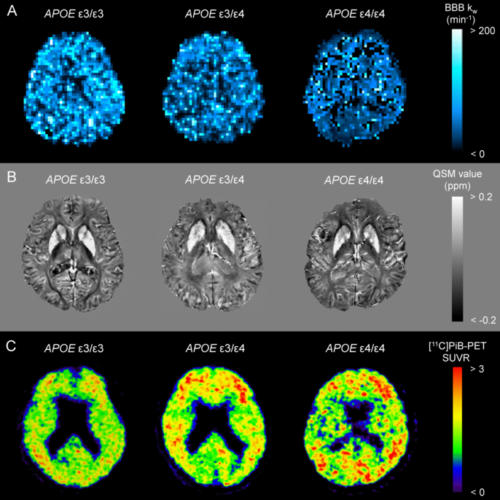 A new biomarker for blood–brain barrier dysfunction in Alzheimer’s disease