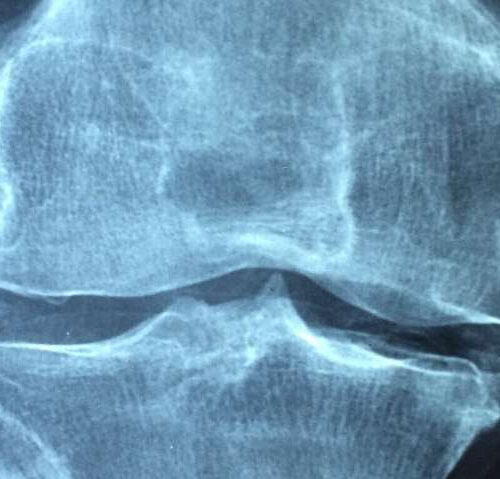 Osteoarthritis: Realigning bad knees may prompt the body to generate cartilage again