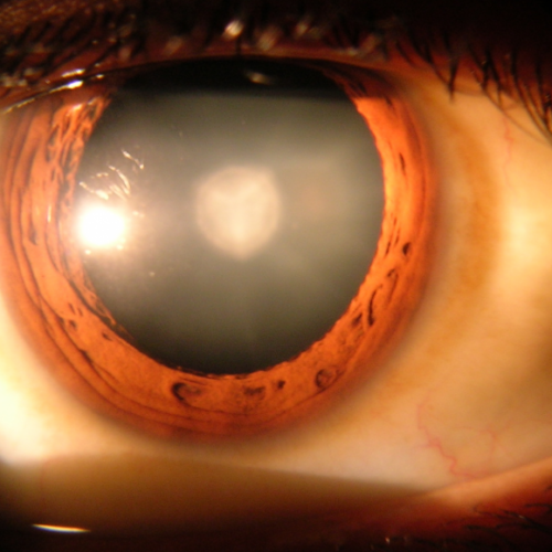 Drug treatment for cataracts moves a step closer