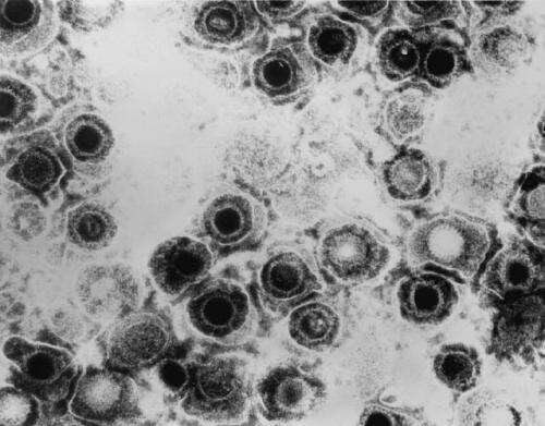 New study reveals that herpesvirus infection may increase risk of developing diabetes
