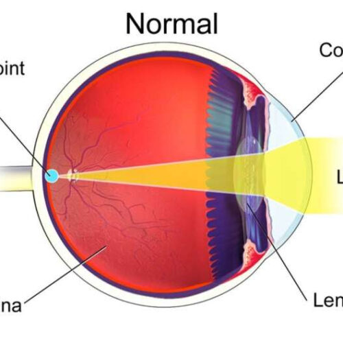 New eye drops can help aging people see better: An optometrist explains how Vuity treats presbyopia