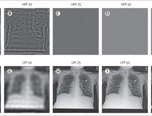 Artificial intelligence predicts patients’ race from their medical images