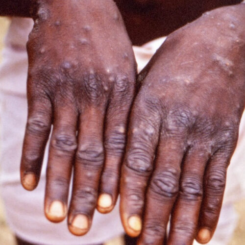 All About Monkeypox