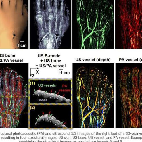 3D bimodal photoacoustic ultrasound imaging to diagnose peripheral vascular diseases