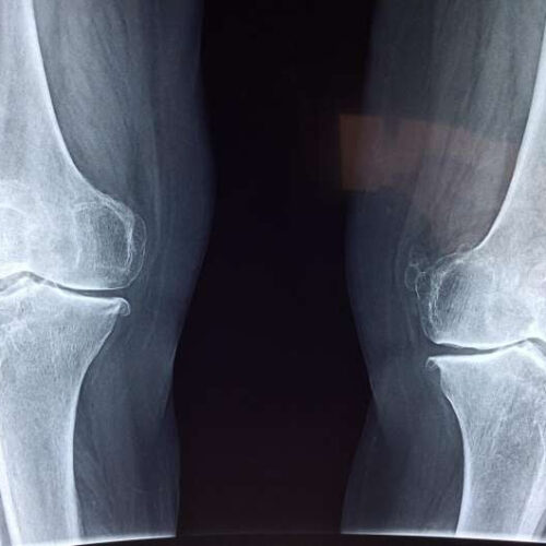 Osteoporosis in men overlooked by doctors and patients