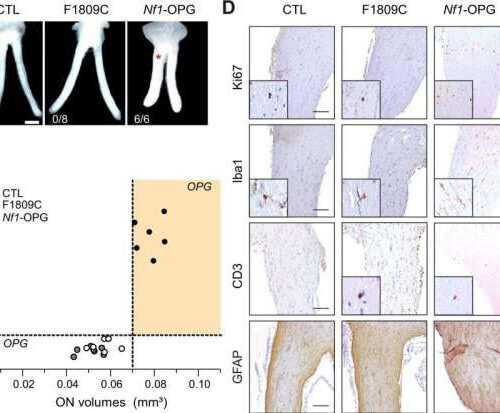 Epilepsy drug stops nervous system tumor growth in mice