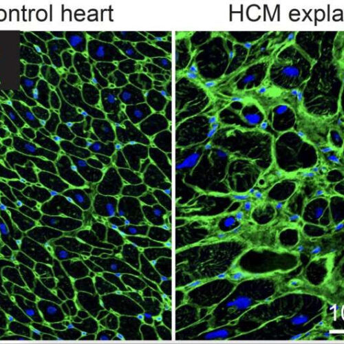 Single cell RNA sequencing uncovers new mechanisms of heart disease