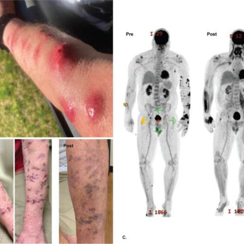 Single bacteriophage used to treat immunocompromised patient with antibiotic resistant infection