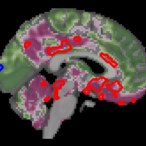 Type 2 diabetes accelerates brain aging and cognitive decline