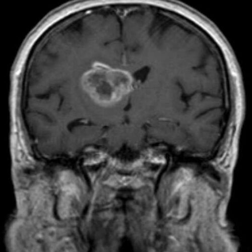 Drug combination that might prove effective for one in three glioblastoma patients