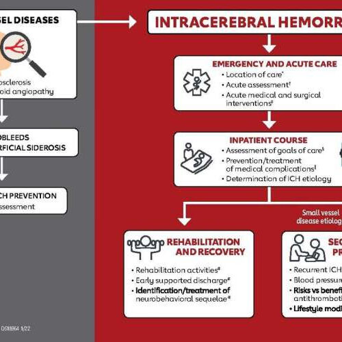 New guideline refines care for brain bleeds: Compression socks, some meds not effective