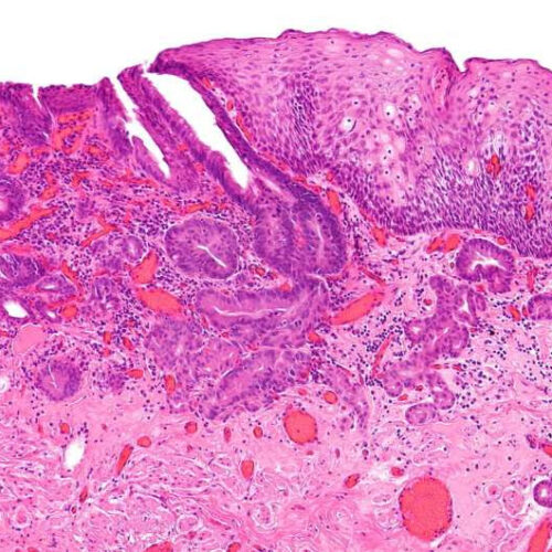 Minimally invasive diagnostic biomarker strategy successful in detecting early esophageal cancer