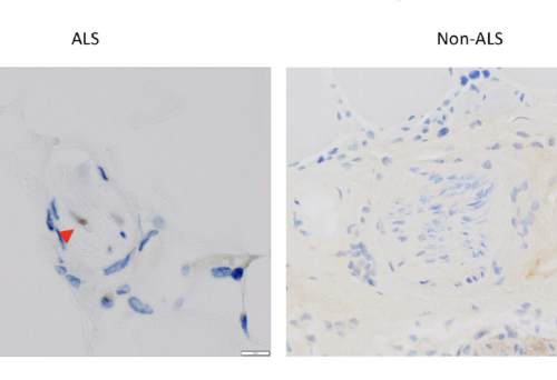 Muscle biopsy test for biomarker could lead to earlier diagnosis of ALS