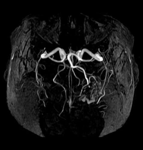 Thalidomide is an effective treatment for abnormal blood vessel formations