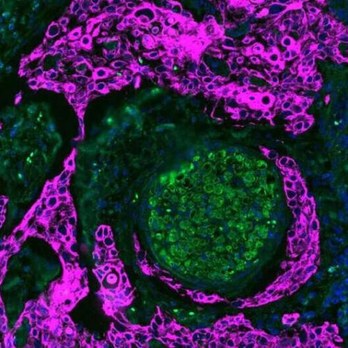 Researchers look at space between nerves and tumor cells to identify most aggressive oral cancers