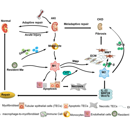 Chinese Medical Journal review explores the role of macrophages in the progression of acute kidney injury to chronic kidney disease