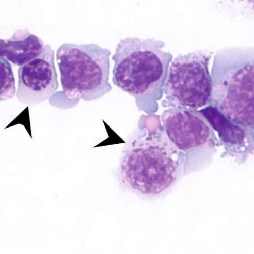 New drug combination shows promise in treating acute myeloid leukemia