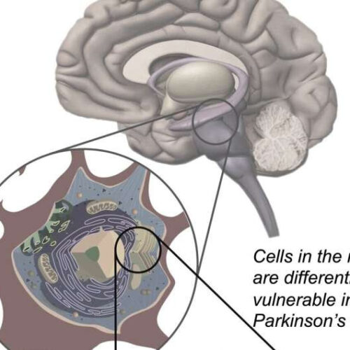 Clinical trial suggests Parkinson’s drug is safe in humans