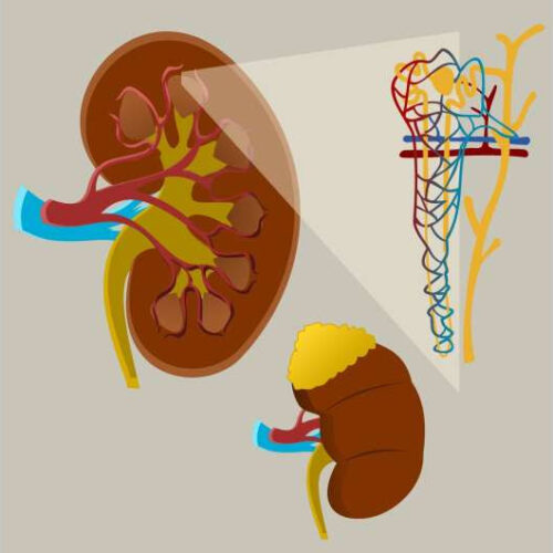 COVID kidney injury may be twice as common as diagnosed