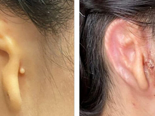 Doctors Transplant 3-D Printed Ear Made of Human Cells