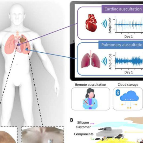 A soft wearable stethoscope designed for automated remote disease diagnosis