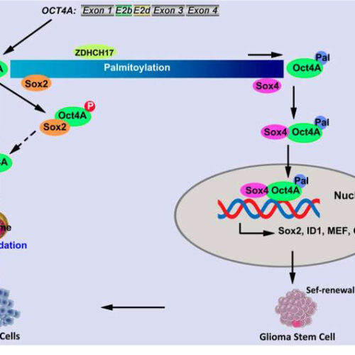 Key factor found in tumorigenicity of glioma stem cells