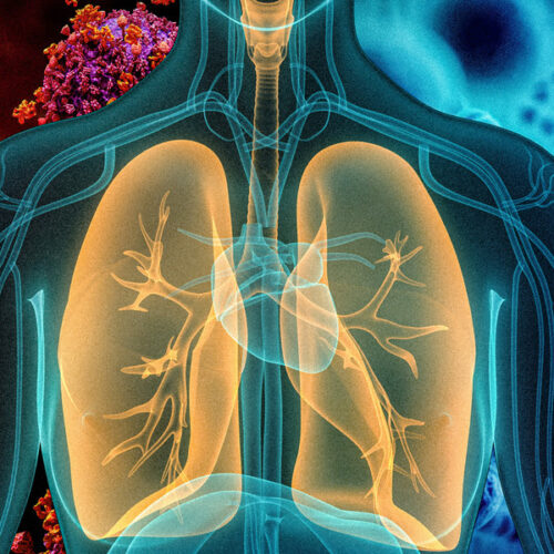 Nanoparticle sensor can distinguish between viral and bacterial pneumonia